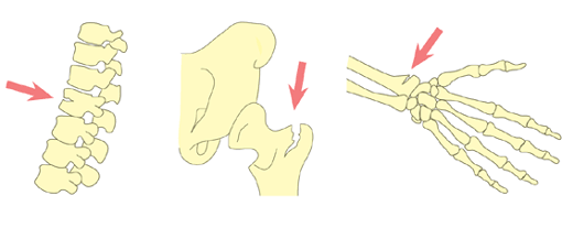 骨粗鬆症の症状