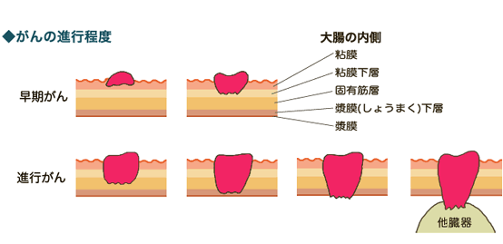 大腸がんの治療